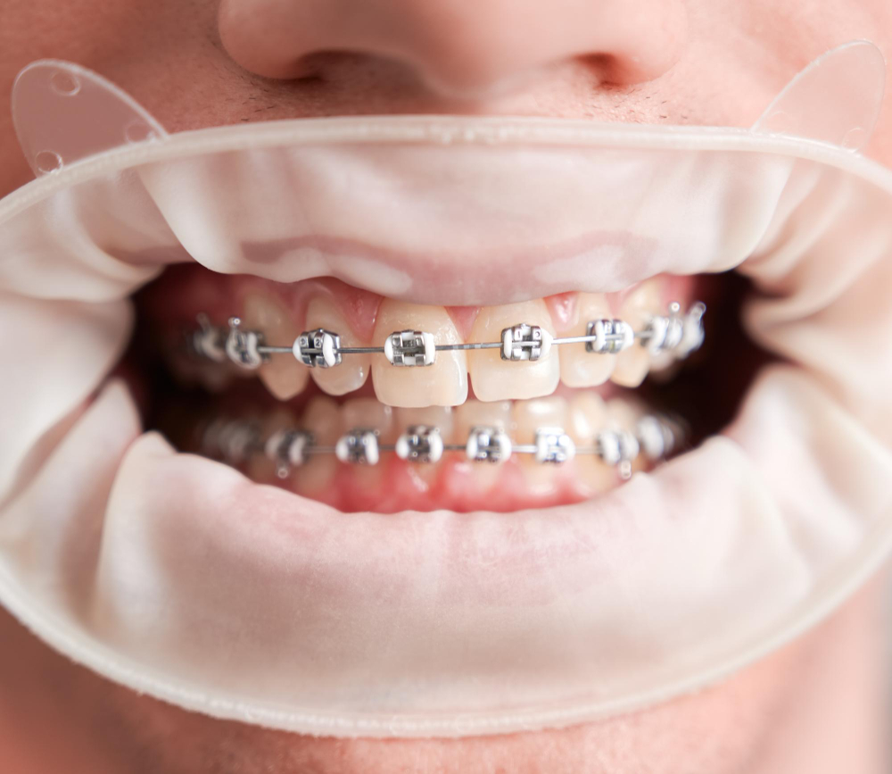 Damon Braces in Anaheim & Buena Park